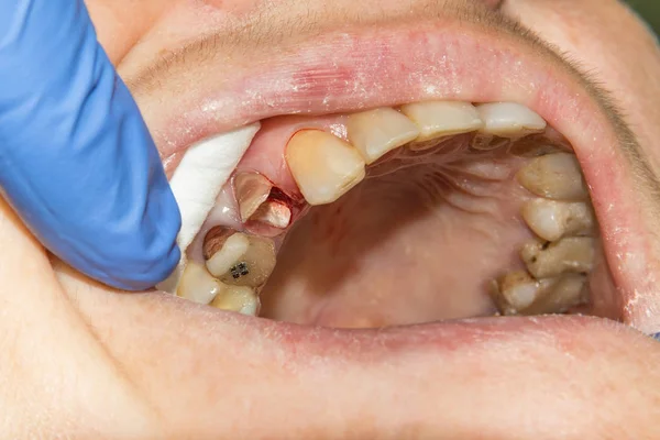Θεραπεία Των Ριζών Των Δοντιών Σφράγιση Και Τον Καθαρισμό Ένα — Φωτογραφία Αρχείου
