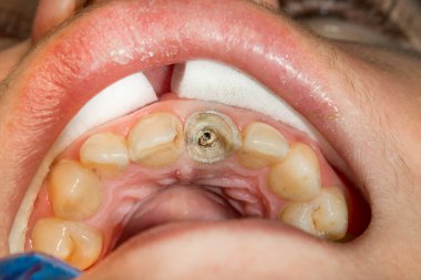 bir insan çürük carious diş tedavi aşamasında bir diş kliniğinde yakın çekim. Kauçuk baraj sistemiyle lateks eşarp ve metal klipleri, photopolymeric kompozit dolgular üretiminde kullanımı