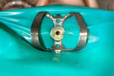 closeup insan dişi çürük diş dolgu kliniğinde tedavi. Ochistka ve kauçuk Barajı mühür sistemi ve evreleme kullanımı ile kanallar