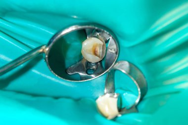 close-up of a human rotten carious tooth at the treatment stage in a dental clinic. The use of rubber dam system with latex scarves and metal clips, production of photopolymeric composite fillings clipart