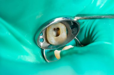 bir insan çürük carious diş tedavi aşamasında bir diş kliniğinde yakın çekim. Kauçuk baraj sistemiyle lateks eşarp ve metal klipleri, photopolymeric kompozit dolgular üretiminde kullanımı