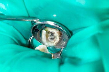 Diş kökleri tedavisinde. Mühürleme ve makro carious insan dişi close-up Temizleme. Yenilik ve teknoloji modern endodontik tedavi hastaların kavramı