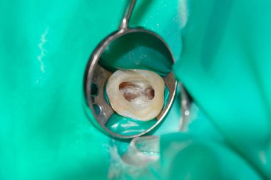 Diş kökleri tedavisinde. Mühürleme ve makro carious insan dişi close-up Temizleme. Yenilik ve teknoloji modern endodontik tedavi hastaların kavramı