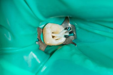 endodontik tedavi diş yakın çekim. Onların dolum ve diş köklerinin temizlik. Diş kliniğinde modern teknoloji kavramı