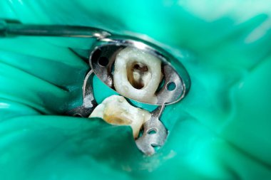 Diş kökleri tedavisinde. Mühürleme ve makro carious insan dişi close-up Temizleme. Yenilik ve teknoloji modern endodontik tedavi hastaların kavramı