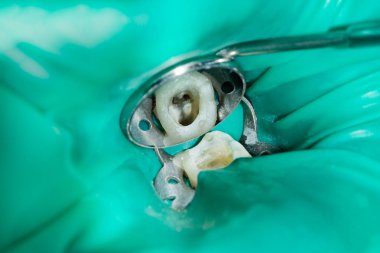endodontik tedavi diş yakın çekim. Onların dolum ve diş köklerinin temizlik. Diş kliniğinde modern teknoloji kavramı