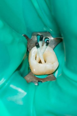 Diş kökleri tedavisinde. Mühürleme ve makro carious insan dişi close-up Temizleme. Yenilik ve teknoloji modern endodontik tedavi hastaların kavramı