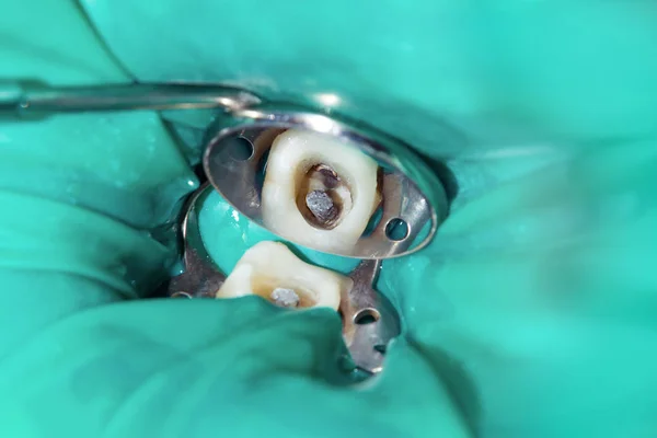 牙齿根部的治疗 封闭和清洁一个龋齿的人牙特写的宏 现代牙髓治疗中的创新与技术理念 — 图库照片
