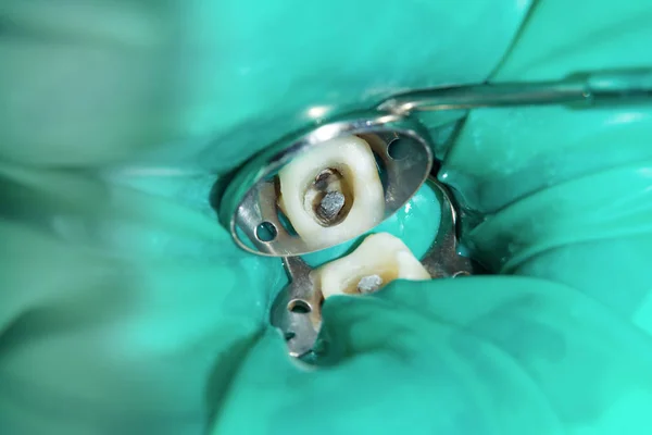 Ендодонтичне Лікування Зубів Крупним Планом Очищення Коренів Зубів Заповнення Концепція — стокове фото