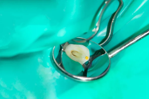 old gold tooth crowns in the mouth of a patient in a dental clinic