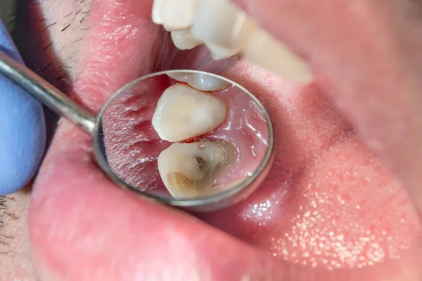old gold tooth crowns in the mouth of a patient in a dental clinic
