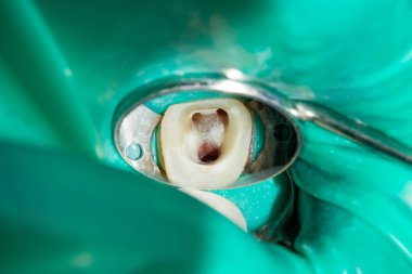 Diş kökleri tedavisinde. Mühürleme ve makro carious insan dişi close-up Temizleme. Yenilik ve teknoloji modern endodontik tedavi hastaların kavramı
