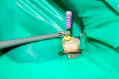 Diş kökleri tedavisinde. Mühürleme ve makro carious insan dişi close-up Temizleme. Yenilik ve teknoloji modern endodontik tedavi hastaların kavramı