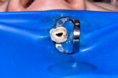 Diş kökleri tedavisinde. Mühürleme ve makro carious insan dişi close-up Temizleme. Yenilik ve teknoloji modern endodontik tedavi hastaların kavramı