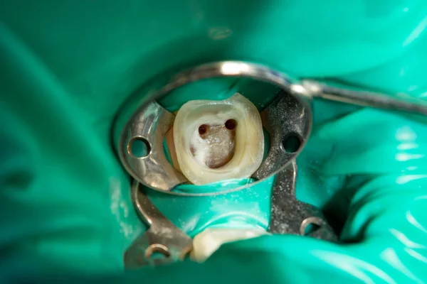 Ενδοδοντική Θεραπεία Δοντιών Close Καθάρισμα Των Ριζών Των Δοντιών Και — Φωτογραφία Αρχείου