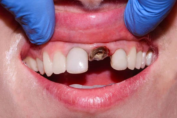 확대해 Endodontic 치료입니다 치아와 그들의 작성의 뿌리의 클리닉에서 기술의 — 스톡 사진