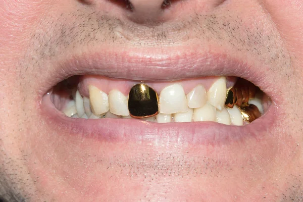 old gold tooth crowns in the mouth of a patient in a dental clinic