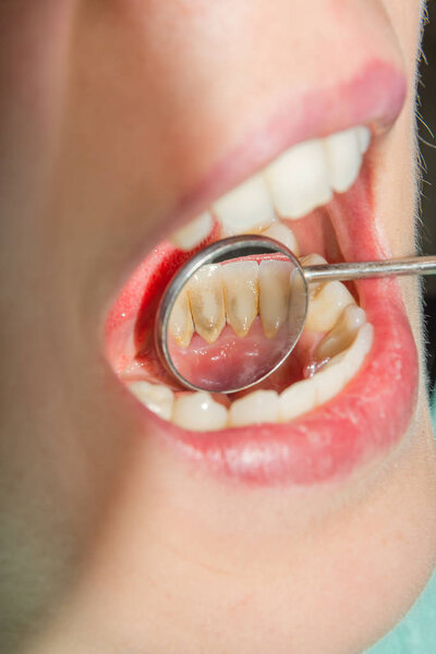 tartar close-up on the lower anterior incisors. Dental hygiene of teeth