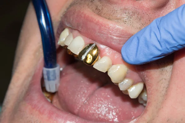 Old Gold Tooth Crowns Mouth Patient Dental Clinic — Stock Photo, Image