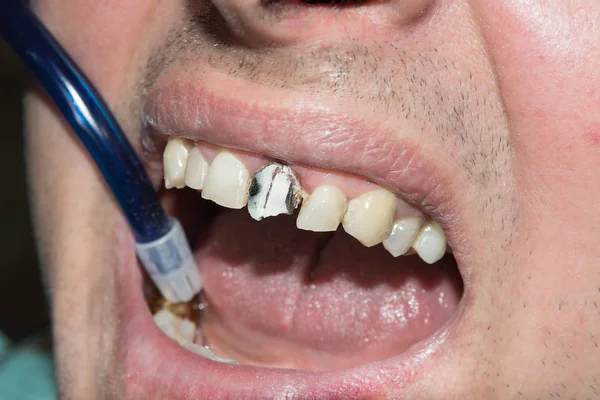Kaz Zkažený Zub Closeup Fotografoval Přes Zubní Zrcátka — Stock fotografie