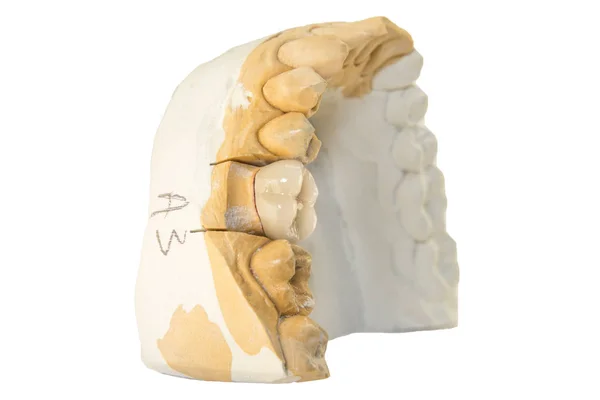 인간의 모델에 크라운입니다 치아의 해부학 크라운을 과정의 매크로 클로즈업 복원의 — 스톡 사진