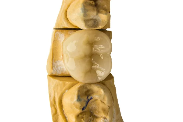 세라믹 세라믹 크라운입니다 치아의 크라운을 만들기 — 스톡 사진