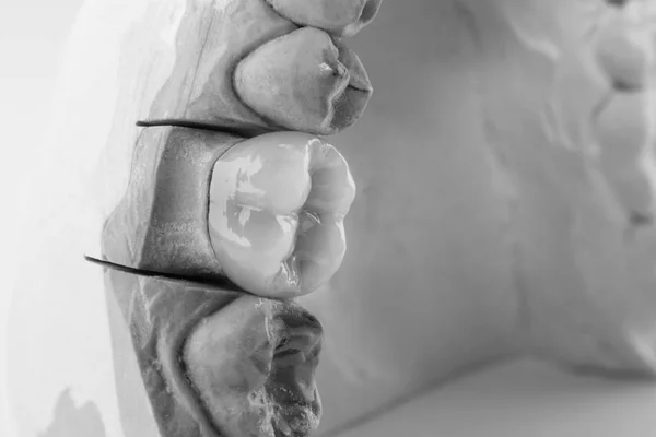 tooth crown on plaster model of human jaw. Macro close-up of the process of manufacturing an anatomical crown of a tooth. The concept of dental restoration of teeth