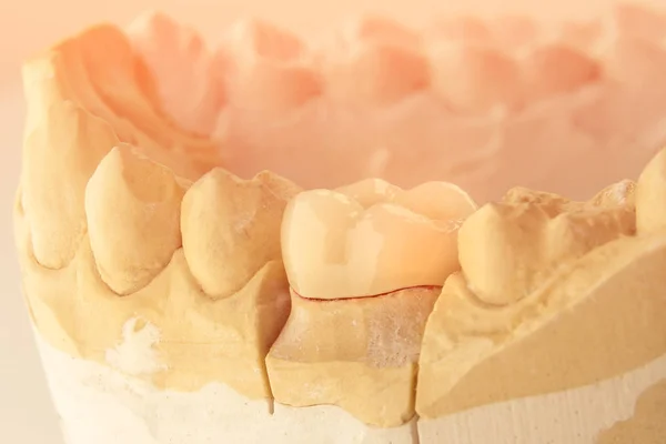 Coroa Cerâmica Cerâmica Fazendo Uma Coroa Porcelana Dente Conceito Prótese — Fotografia de Stock