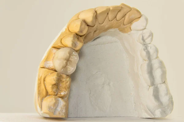 tooth crown on plaster model of human jaw. Macro close-up of the process of manufacturing an anatomical crown of a tooth. The concept of dental restoration of teeth