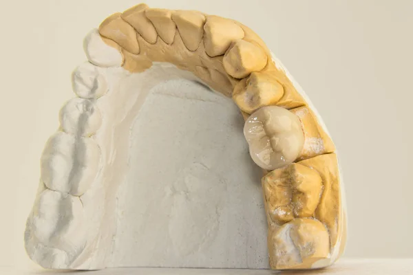 Corona Del Dente Sul Modello Gesso Della Mascella Umana Macro — Foto Stock