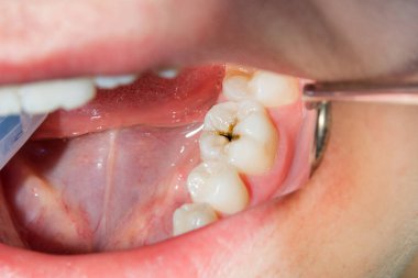 bir insan çürük carious diş tedavi aşamasında bir diş kliniğinde yakın çekim. Kauçuk baraj sistemiyle lateks eşarp ve metal klipleri, photopolymeric kompozit dolgular üretiminde kullanımı