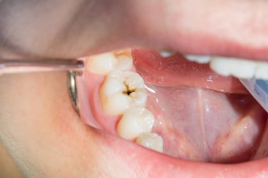bir insan çürük carious diş tedavi aşamasında bir diş kliniğinde yakın çekim. Kauçuk baraj sistemiyle lateks eşarp ve metal klipleri, photopolymeric kompozit dolgular üretiminde kullanımı