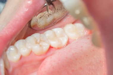 bir insan çürük carious diş tedavi aşamasında bir diş kliniğinde yakın çekim. Kauçuk baraj sistemiyle lateks eşarp ve metal klipleri, photopolymeric kompozit dolgular üretiminde kullanımı
