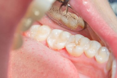 bir insan çürük carious diş tedavi aşamasında bir diş kliniğinde yakın çekim. Kauçuk baraj sistemiyle lateks eşarp ve metal klipleri, photopolymeric kompozit dolgular üretiminde kullanımı