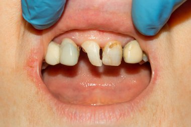 bir insan çürük carious diş tedavi aşamasında bir diş kliniğinde yakın çekim. Kauçuk baraj sistemiyle lateks eşarp ve metal klipleri, photopolymeric kompozit dolgular üretiminde kullanımı