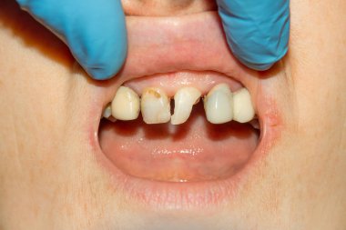 bir insan çürük carious diş tedavi aşamasında bir diş kliniğinde yakın çekim. Kauçuk baraj sistemiyle lateks eşarp ve metal klipleri, photopolymeric kompozit dolgular üretiminde kullanımı