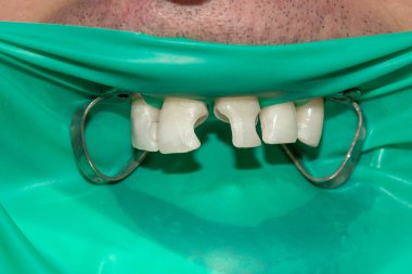 bir insan çürük carious diş tedavi aşamasında bir diş kliniğinde yakın çekim. Kauçuk baraj sistemiyle lateks eşarp ve metal klipleri, photopolymeric kompozit dolgular üretiminde kullanımı