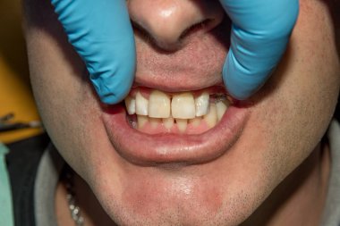 bir insan çürük carious diş tedavi aşamasında bir diş kliniğinde yakın çekim. Kauçuk baraj sistemiyle lateks eşarp ve metal klipleri, photopolymeric kompozit dolgular üretiminde kullanımı