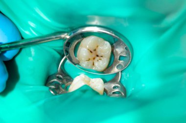 bir insan çürük carious diş tedavi aşamasında bir diş kliniğinde yakın çekim. Kauçuk baraj sistemiyle lateks eşarp ve metal klipleri, photopolymeric kompozit dolgular üretiminde kullanımı