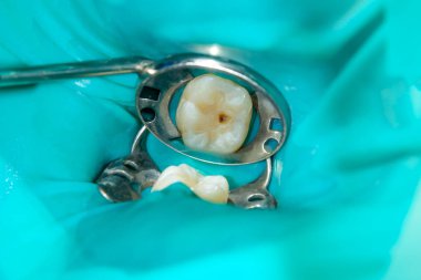 bir insan çürük carious diş tedavi aşamasında bir diş kliniğinde yakın çekim. Kauçuk baraj sistemiyle lateks eşarp ve metal klipleri, photopolymeric kompozit dolgular üretiminde kullanımı