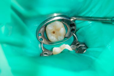 bir insan çürük carious diş tedavi aşamasında bir diş kliniğinde yakın çekim. Kauçuk baraj sistemiyle lateks eşarp ve metal klipleri, photopolymeric kompozit dolgular üretiminde kullanımı