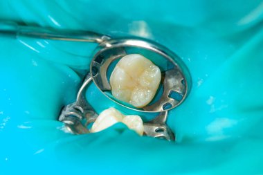 bir insan çürük carious diş tedavi aşamasında bir diş kliniğinde yakın çekim. Kauçuk baraj sistemiyle lateks eşarp ve metal klipleri, photopolymeric kompozit dolgular üretiminde kullanımı