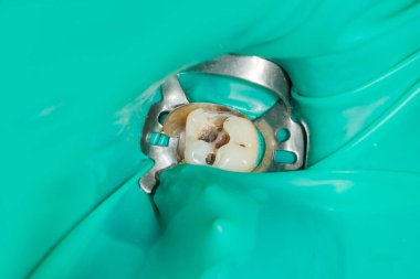 bir insan çürük carious diş tedavi aşamasında bir diş kliniğinde yakın çekim. Kauçuk baraj sistemiyle lateks eşarp ve metal klipleri, photopolymeric kompozit dolgular üretiminde kullanımı