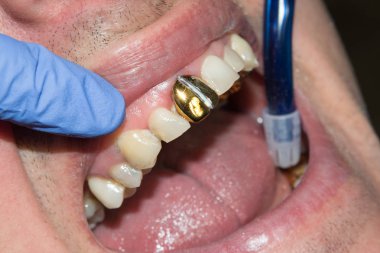 Fotoğraf endodontik tedavi alt azı kalıcı diş Endodontik dosyasıyla molar diş kanallar ile apex arama, diş cofferdam tarafından bağlı kelepçe ile