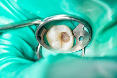 bir insan çürük carious diş tedavi aşamasında bir diş kliniğinde yakın çekim. Kauçuk baraj sistemiyle lateks eşarp ve metal klipleri, photopolymeric kompozit dolgular üretiminde kullanımı