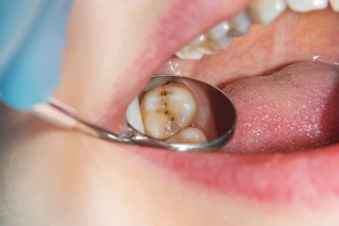 bir insan çürük carious diş tedavi aşamasında bir diş kliniğinde yakın çekim. Kauçuk baraj sistemiyle lateks eşarp ve metal klipleri, photopolymeric kompozit dolgular üretiminde kullanımı