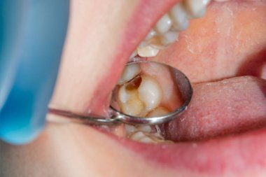 bir insan çürük carious diş tedavi aşamasında bir diş kliniğinde yakın çekim. Kauçuk baraj sistemiyle lateks eşarp ve metal klipleri, photopolymeric kompozit dolgular üretiminde kullanımı