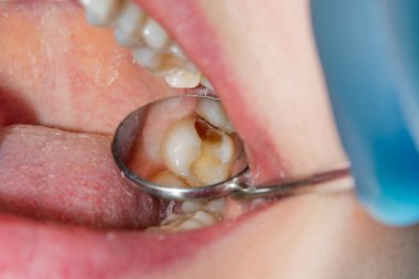 Bir insan dişi yakın çekim çürük tedavisinde. Kompozit malzeme ile diş diş restorasyon kavramı.