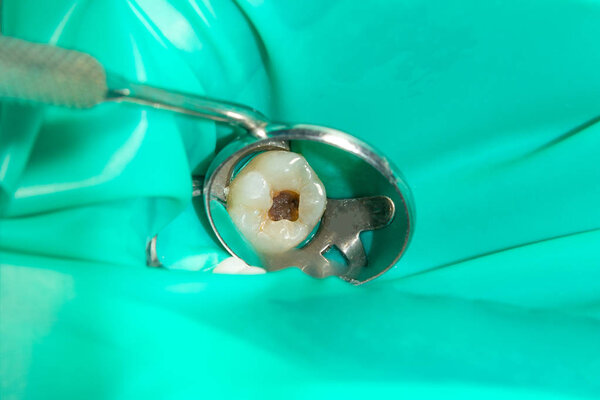 крупным планом гнилого кариозного зуба человека на стадии лечения в стоматологической клинике. Использование системы резиновых плотин с латексными шарфами и металлическими зажимами, производство фотополимерных композитных пломб
