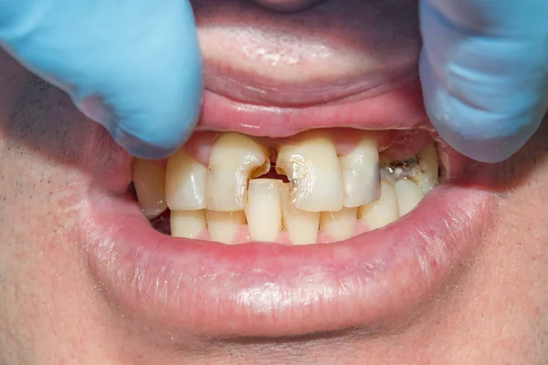 在牙科诊所的治疗阶段 一个人腐烂的龋齿牙齿的特写 橡胶坝系统与乳胶围巾和金属夹的使用 Photopolymeric 复合填料的生产 — 图库照片